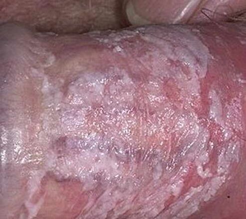 descarga coagulada cando se excita