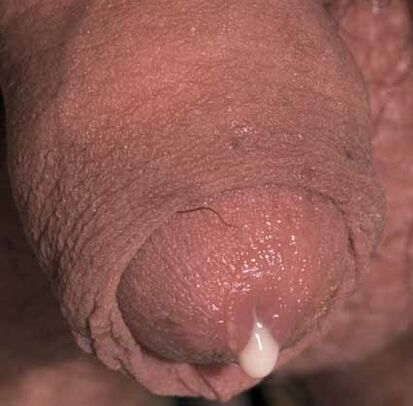 descarga patolóxica cando se excita